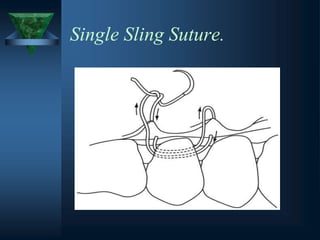 Single Sling Suture.
 