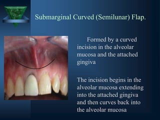 Submarginal Curved (Semilunar) Flap.
Formed by a curved
incision in the alveolar
mucosa and the attached
gingiva
The incision begins in the
alveolar mucosa extending
into the attached gingiva
and then curves back into
the alveolar mucosa
 