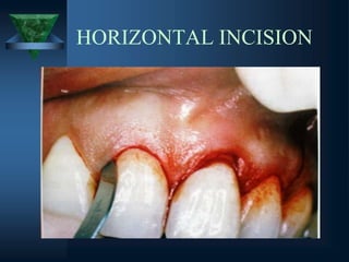 HORIZONTAL INCISION
 