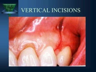 VERTICAL INCISIONS
 