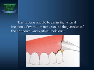 This process should begin in the vertical
incision a few millimeter apical to the junction of
the horizontal and vertical incisions.
 