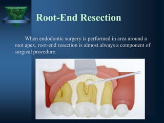 Root-End Resection
When endodontic surgery is performed in area around a
root apex, root-end resection is almost always a component of
surgical procedure.
 
