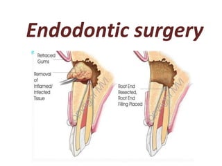 Endodontic surgery
 