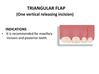 TRIANGULAR FLAP
(One vertical releasing incision)
INDICATIONS
• It is recommended for maxillary
incisors and posterior teeth.
 