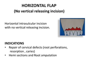 HORIZONTAL FLAP
(No vertical releasing incision)
Horizontal intrasulcular incision
with no vertical releasing incision.
INDICATIONS
• Repair of cervical defects (root perforations,
resorption , caries)
• Hemi sections and Root amputation
 