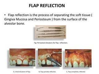 FLAP REFLECTION
• Flap reflection is the process of separating the soft tissue (
Gingiva Mucosa and Periosteum ) from the surface of the
alveolar bone.
Fig: Periosteal elevators for flap reflection;
A, Initial elevation of flap; B, Flap partially reflected; C, Flap completely reflected.
 
