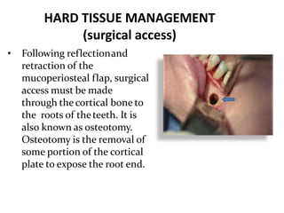 HARD TISSUE MANAGEMENT
(surgical access)
• Following reflectionand
retraction of the
mucoperiosteal flap, surgical
access must be made
through the cortical bone to
the roots of theteeth. It is
also known as osteotomy.
Osteotomy is the removal of
some portion of the cortical
plate to expose the root end.
 