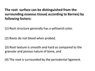 The root surface can be distinguished from the
surrounding osseous tissue( according to Barnes) by
following factors:
(1) Root structure generally has a yellowish color.
(2) Roots do not bleed when probed.
(3) Root texture is smooth and hard as compared to the
granular and porous nature of bone, and
(4) The root is surrounded by the periodontal ligament..
 