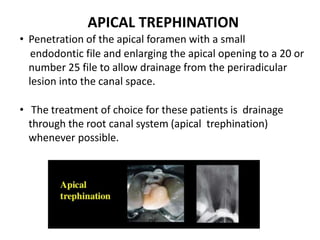 APICAL TREPHINATION
• Penetration of the apical foramen with a small
endodontic file and enlarging the apical opening to a 20 or
number 25 file to allow drainage from the periradicular
lesion into the canal space.
• The treatment of choice for these patients is drainage
through the root canal system (apical trephination)
whenever possible.
 