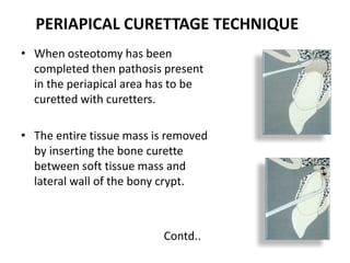 PERIAPICAL CURETTAGE TECHNIQUE
• When osteotomy has been
completed then pathosis present
in the periapical area has to be
curetted with curetters.
• The entire tissue mass is removed
by inserting the bone curette
between soft tissue mass and
lateral wall of the bony crypt.
Contd..
 