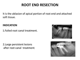 It is the ablasion of apical portion of root end and attached
soft tissue.
INDICATION
ROOT END RESECTION
1.Failed root canal treatment.
2.Large persistent lesions
after root canal treatment.
Large unresolved lesions after
root canal treatment :
 