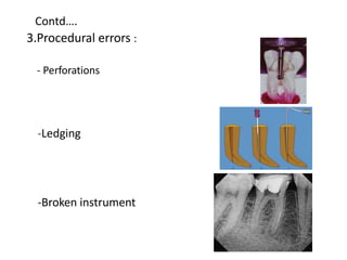 Contd….
3.Procedural errors :
- Perforations
-Ledging
-Broken instrument
 