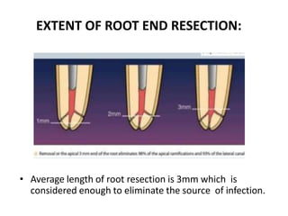 EXTENT OF ROOT END RESECTION:
• Average length of root resection is 3mm which is
considered enough to eliminate the source of infection.
 