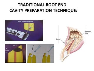 TRADITIONAL ROOT END
CAVITY PREPARATION TECHNIQUE:
 