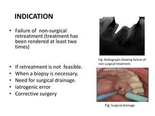 INDICATION
• Failure of non-surgical
retreatment (treatment has
been rendered at least two
times)
• If retreatment is not feasible.
• When a biopsy is necessary.
• Need for surgical drainage.
• Iatrogenic error
• Corrective surgery
Fig: Surgical drainage
Fig: Radiograph showing failure of
non surgical treatment.
 