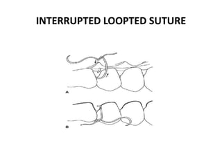INTERRUPTED LOOPTED SUTURE
 