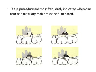 • These procedure are most frequently indicated when one
root of a maxillary molar must be eliminated.
 