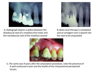 A, Radiograph depicts a defect between the
distobuccal root of a maxillary first molar and
the mesiobuccal root of the maxillary second
B, Root canal therapy is completed
and an amalgam core is placed into
the root to be amputated
C, The same case 4 years after the amputation procedure, note the presence of
A well-contoured crown and the health of the interproximal periodontal
tissues.
 
