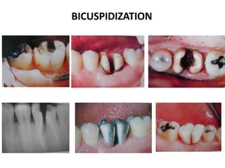 BICUSPIDIZATION
 