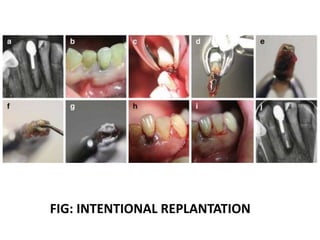 FIG: INTENTIONAL REPLANTATION
 