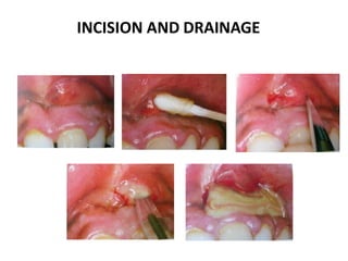 INCISION AND DRAINAGE
 