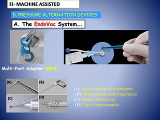 5. PRESSURE ALTERNATION DEVICES
A. The EndoVac System….
Multi-Port Adapter (MPA)
ІІ- MACHINE ASSISTED
(B)
(C) (D)
(A)
(A) Macrocannula with handpiec
(B) Microcannula with fingerpiece
(C) Master delivery tip
(D) Tip of microcannula
 
