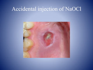 Accidental injection of NaOCl
 