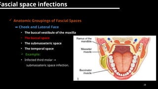 Submasseter Space management of endodotics emergencies.pptx