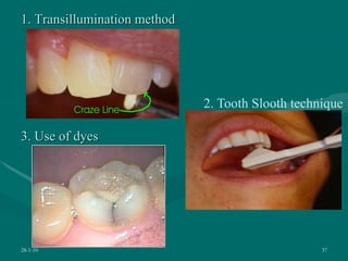1. Transillumination method
3. Use of dyes
28-1-10 37
2. Tooth Slooth technique
 