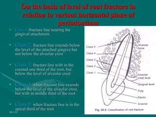 On the basis of level of root fracture in
relation to various horizontal plane of
periodontium
• Class 1:fracture line nearing the
gingival attachment.
• Class 2: fracture line extends below
the level of the attached gingiva but
not below the alveolar crest
• Class 3: fracture line with in the
coronal one third of the root, but
below the level of alveolar crest
• Class 4: when fracture line extends
below the level of the alveolar crest,
but with in middle third of the root
• Class 5: when fracture line is in the
apical third of the root
28-1-10 57
 