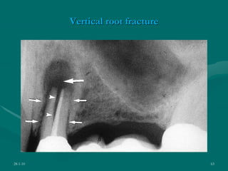 Vertical root fracture
28-1-10 63
 