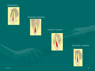 28-1-10 69
Subluxation
Extrusive luxation
Lateral luxation
Intrusive luxation
 
