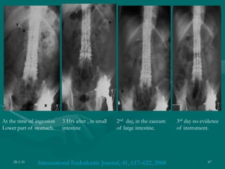 28-1-10 87
International Endodontic Journal, 41, 617–622, 2008
At the time of ingestion
Lower part of stomach.
3 Hrs after , in small
intestine
2nd day, in the caecum
of large intestine.
3rd day no evidence
of instrument.
 