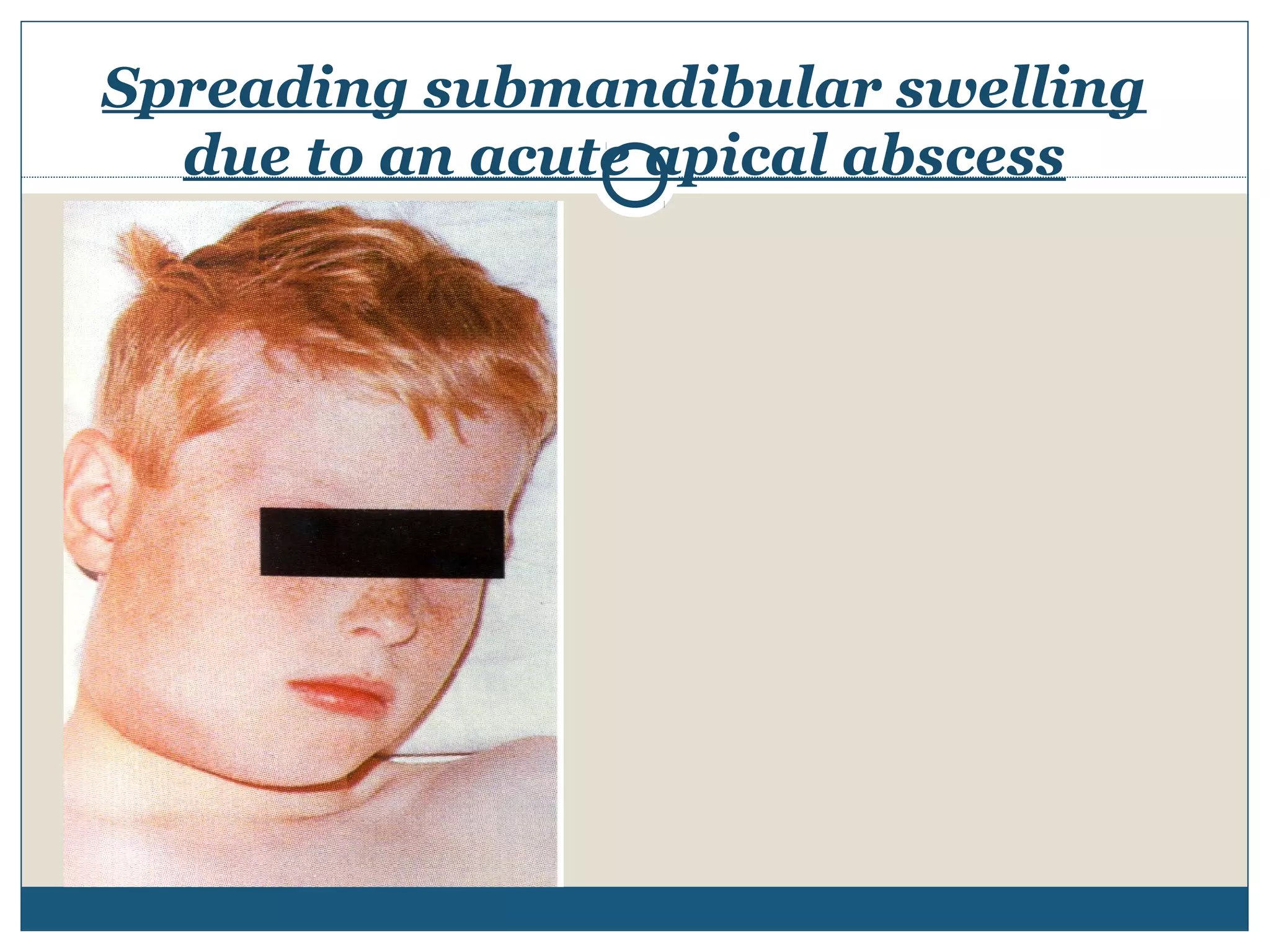 Spreading submandibular swelling 
due to an acute apical abscess 
 