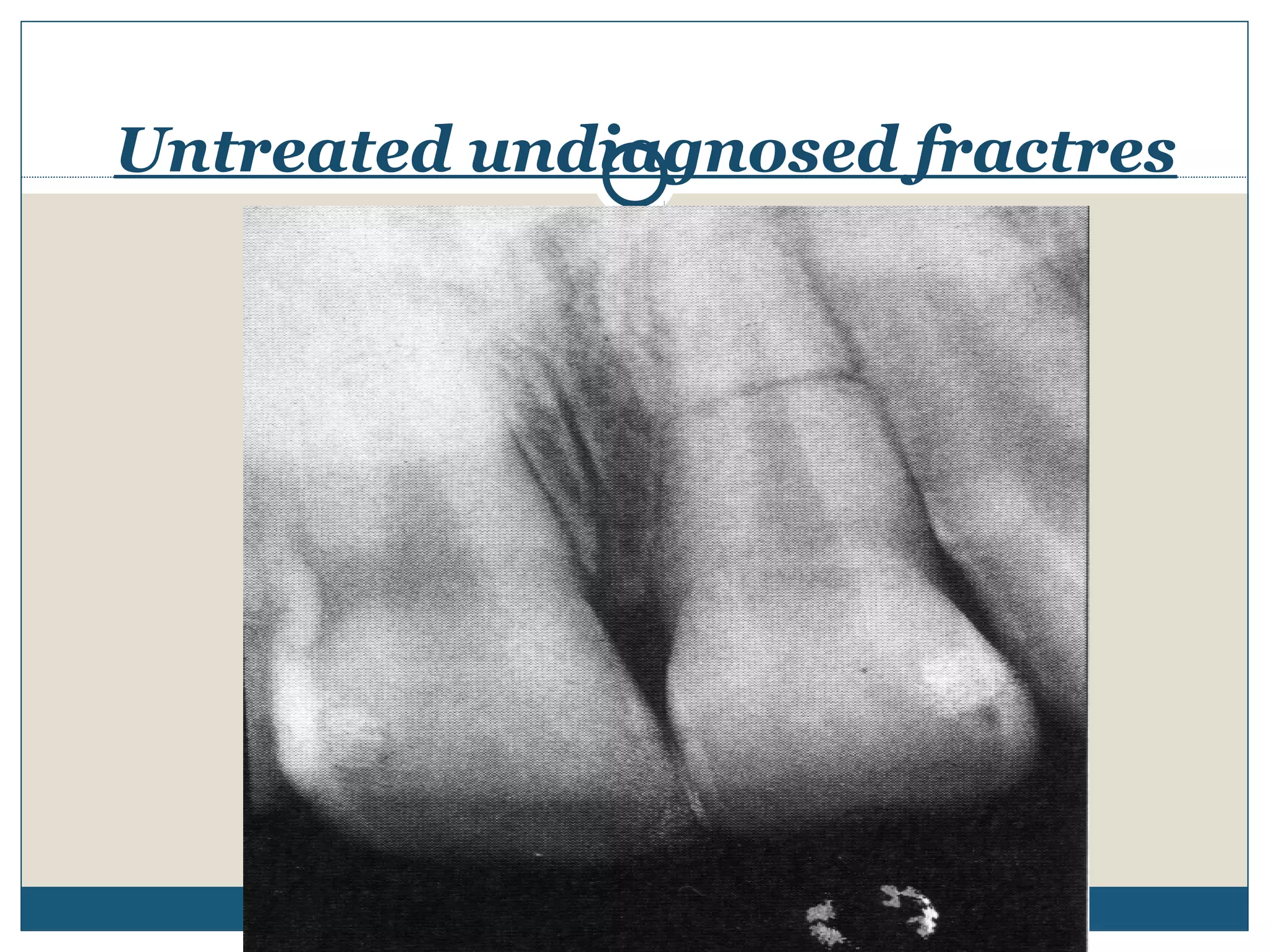 Untreated undiagnosed fractres 
 