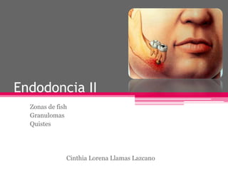 Endodoncia II
Zonas de fish
Granulomas
Quistes
Cinthia Lorena Llamas Lazcano
 