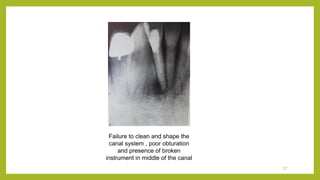 Endo failure | PPT