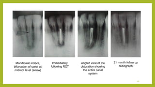 Endo failure | PPT