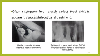 Endo failure | PPT