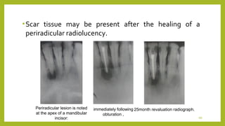 Endo failure | PPT