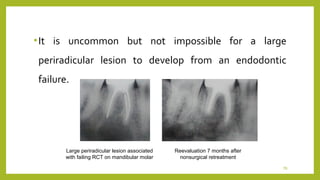 Endo failure | PPT