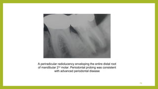 Endo failure | PPT