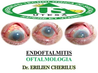 ENDOFTALMITIS
OFTALMOLOGIA
Dr. ERILIEN CHERILUS

 