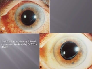 Endoftalmite aguda após 5 dias de
cg catarata. Realizado Inj IV ATB –
20/30
 