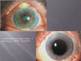 Endoftalmite associada a bolha c 2
anos de cg – VVPP + inj ATB IV
 