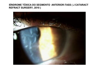 SÍNDROME TÓXICA DO SEGMENTO ANTERIOR-TASS ( J CATARACT
REFRACT SURGERY, 2010 )
 