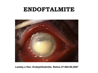 ENDOFTALMITE
Lemley e Han. Endophthalmitis. Retina 27:662-80,2007
 