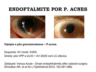 ENDOFTALMITE POR P. ACNES
Hipópio e pks granulomatosos – P.acnes.
Esquerda: AV inicial 5/200;
Direita: pós VPP e s/LIO = AV 20/20 com LC afácica.
(Delayed- Versus Acute - Onset endophthalmitis after cataract surgery
Shirodkar AR. et al Am J Ophthalmol 2012; 153:391-398)
 