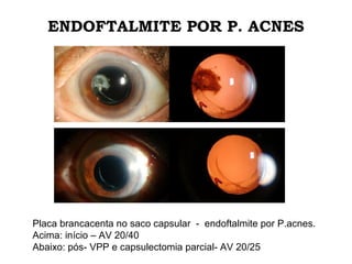ENDOFTALMITE POR P. ACNES
Placa brancacenta no saco capsular - endoftalmite por P.acnes.
Acima: início – AV 20/40
Abaixo: pós- VPP e capsulectomia parcial- AV 20/25
 