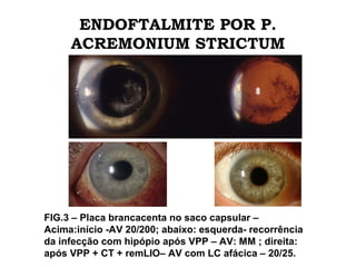 ENDOFTALMITE POR P.
ACREMONIUM STRICTUM
FIG.3 – Placa brancacenta no saco capsular –
Acima:início -AV 20/200; abaixo: esquerda- recorrência
da infecção com hipópio após VPP – AV: MM ; direita:
após VPP + CT + remLIO– AV com LC afácica – 20/25.
 